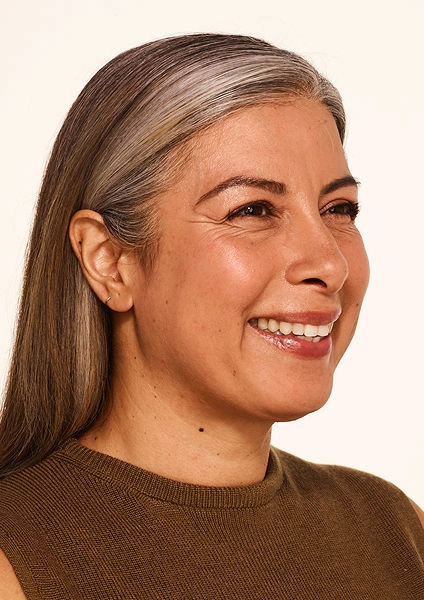 Botox before image